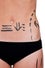 Cellulite-treatment-liposuction